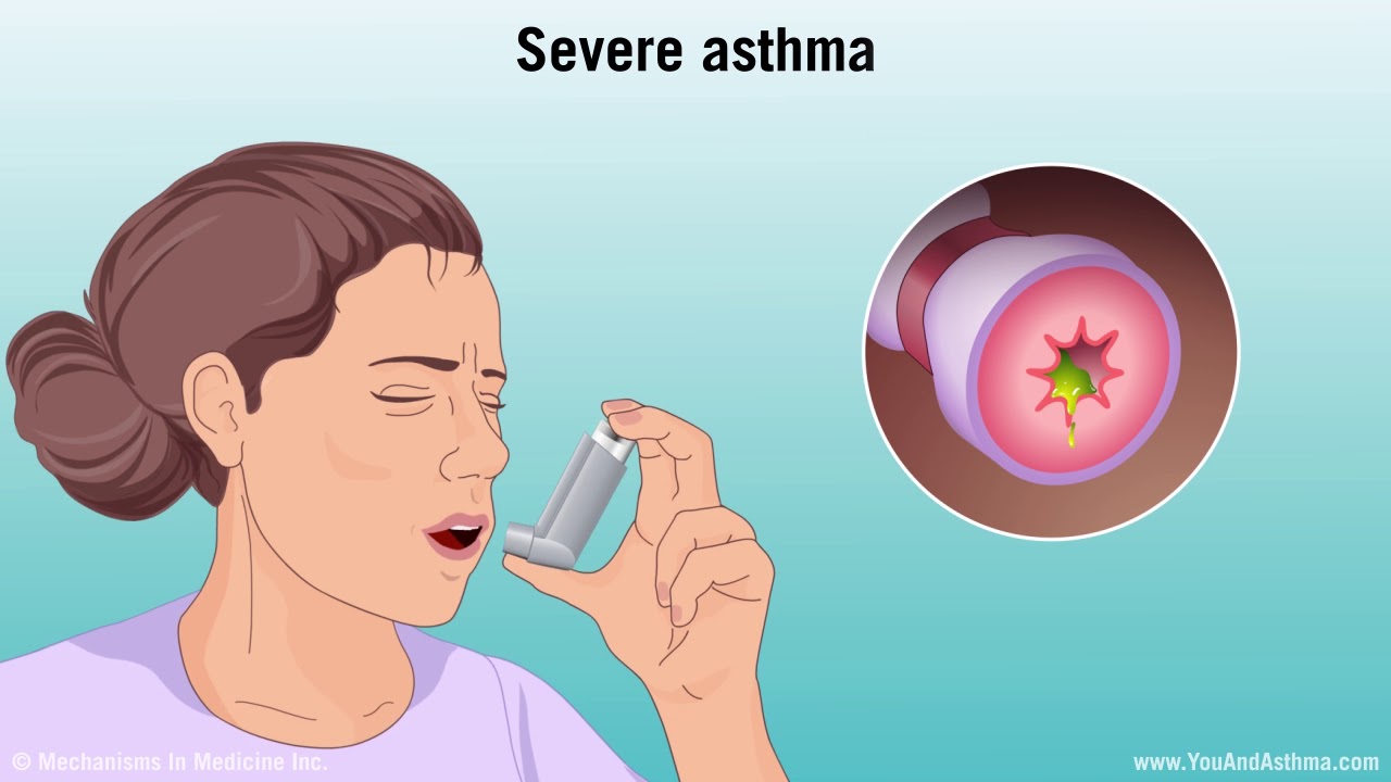 Understanding Asthma Mild Moderate And Severe Intratherapies